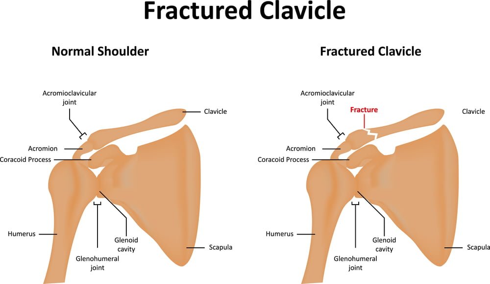 symptoms of calvical fracture