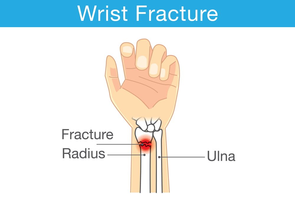 Wrist Fractures