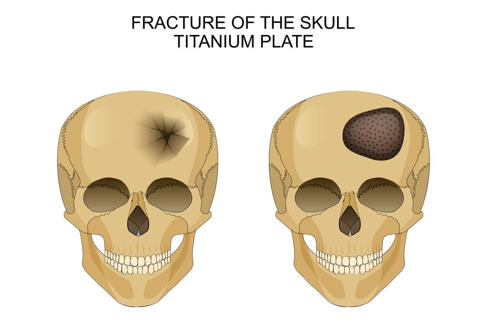 skull fracture