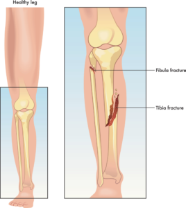 visual of tibia fracture & fibula fracture