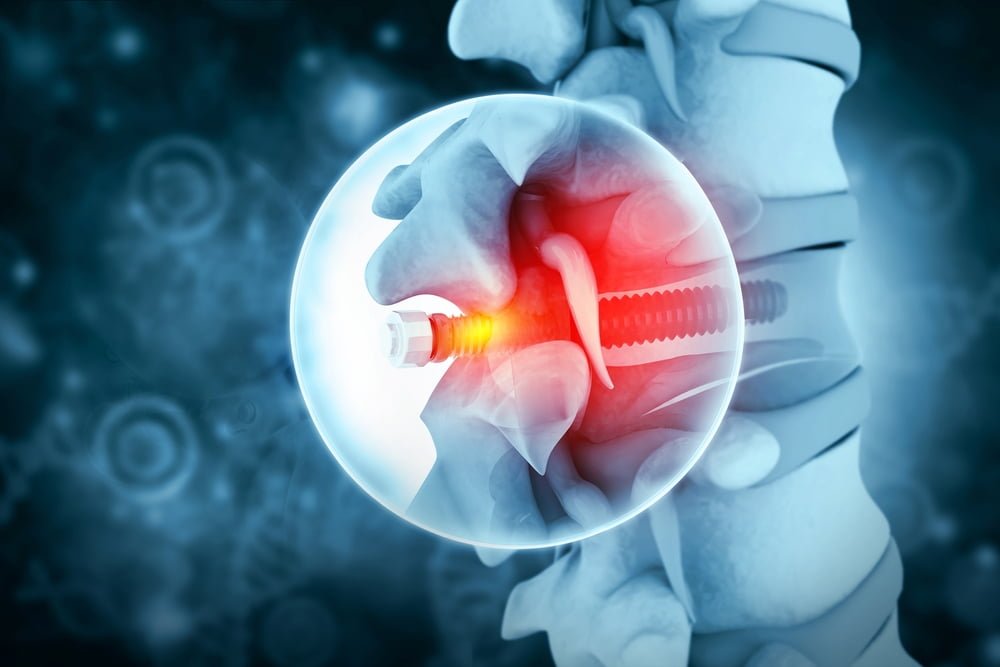 Spine Implants Manufacturer